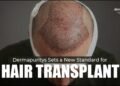 Best hair transplant clinic in Lucknow, hair restoration Lucknow, hair transplant Lucknow, Dermapuritys
