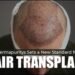Dermapuritys Sets a New Standard for Hair Transplant in Lucknow 2 Best hair transplant clinic in Lucknow, hair restoration Lucknow, hair transplant Lucknow, Dermapuritys